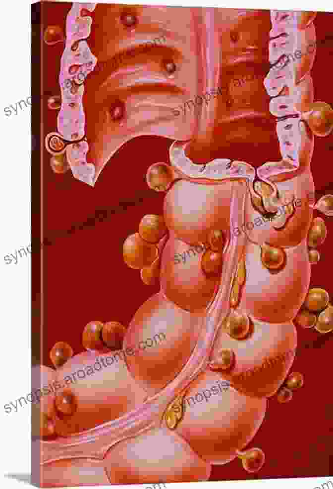 An Illustration Of Diverticula Forming Along The Colon Awesome Diverticulitis Diet For Novices And Dummies