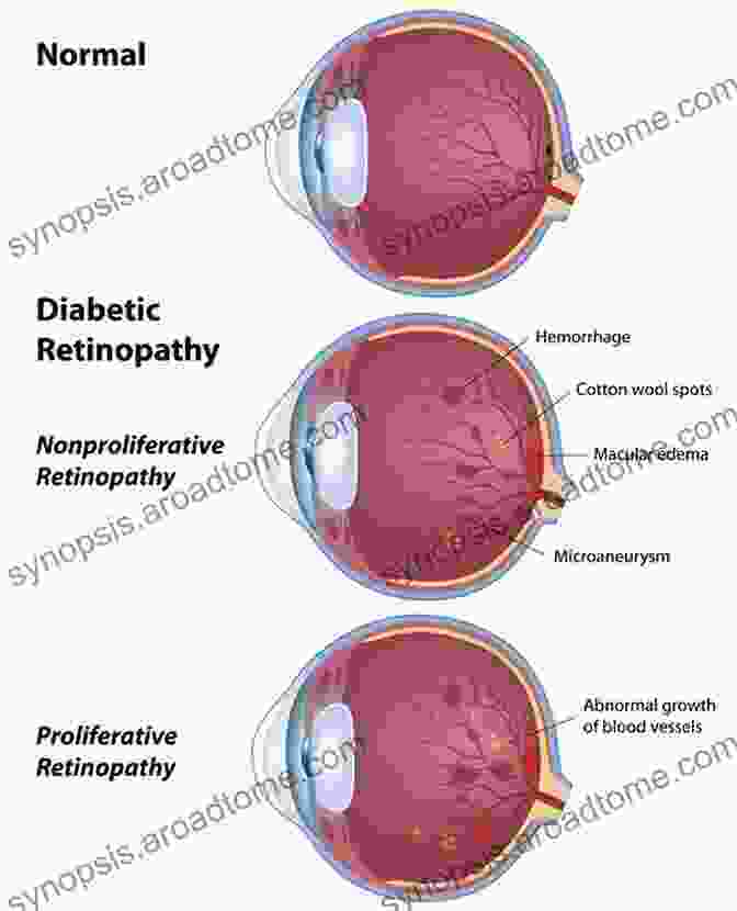 Diabetic Retinopathy Is A Serious Eye Condition That Can Lead To Vision Loss And Even Blindness. It Is Caused By Damage To The Blood Vessels In The Retina, The Light Sensitive Tissue At The Back Of The Eye. Diabetic Retinopathy Is A Common Complication Of Diabetes, And It Is Estimated That More Than 10 Million People In The United States Have This Condition. Diabetic Retinopathy: From Diagnosis To Treatment