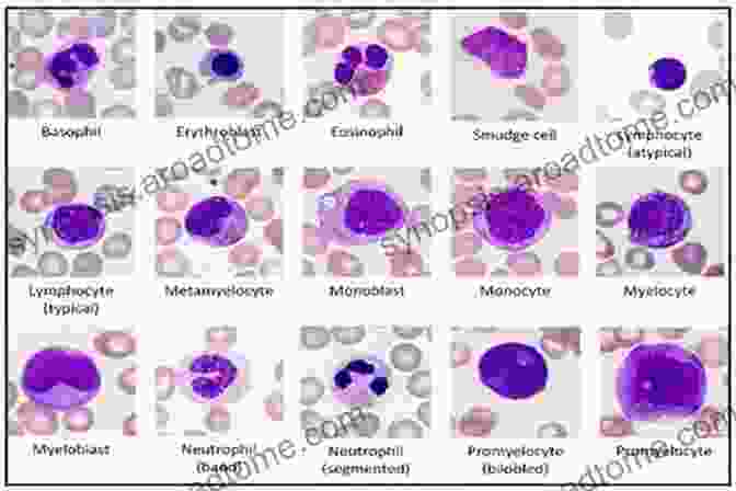 Microscopic Image Of Abnormal Blood Cells, Highlighting The Importance Of Early Diagnosis And Treatment. Crash Course Haematology And Immunology