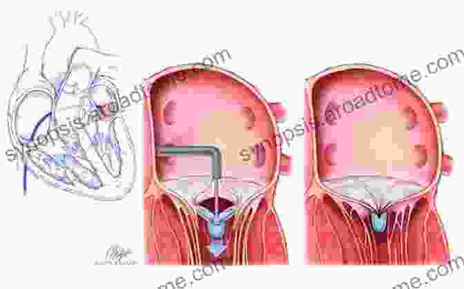 Mitral Valve Repair Surgery Mitral Valve Repair: The Biological Solution